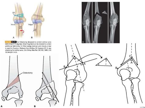 Supracondylar Osteotomy For Treatment Of Cubitus Varus