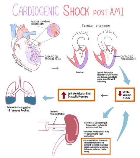 Cardiogenic Shock Adalah Homecare24