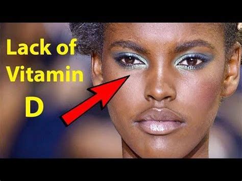 Unusual Signs And Symtoms That Youre Lacking Vitamin D Vitamins