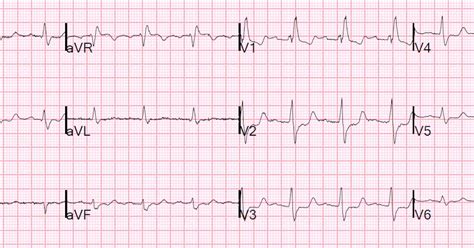 Dr Smith S ECG Blog Right Bundle Branch Block And ST Depression In V1