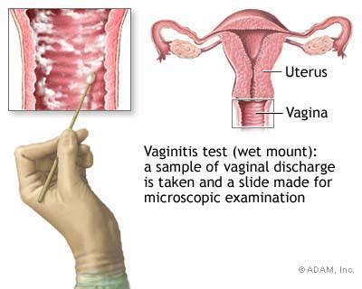 The New York Times Health Image The Wet Mount Vaginitis Test