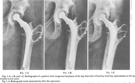 Figure 1 From Charnley Total Hip Arthroplasty In Patients Less Than
