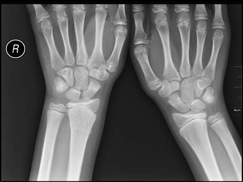 Wrist Sprain Or Broken Wrist How To Tell The Difference