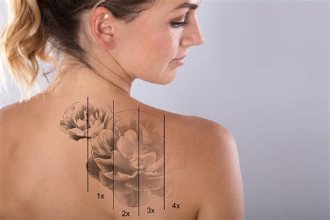 How Many Sessions To Remove My Tattoo Everything You Need To Know About Laser Tattoo Removal