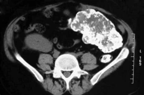 Ct Scan Of Abdomen Showing Large Calcified Mass In Lef Open I