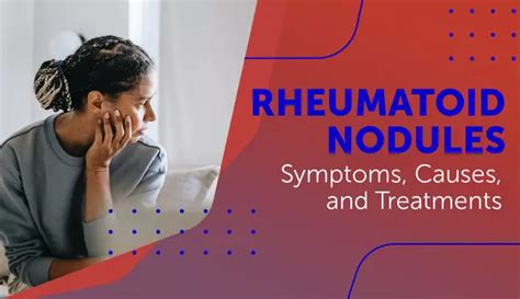 Rheumatoid Nodules Symptoms Causes And Treatments Myrateam