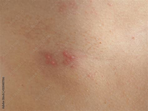 Herpes Zoster Or Shingles In Woman On Her Skin Cause Of Varicella