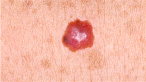 How Dangerous Is Squamous Cell Carcinoma Danger Choices