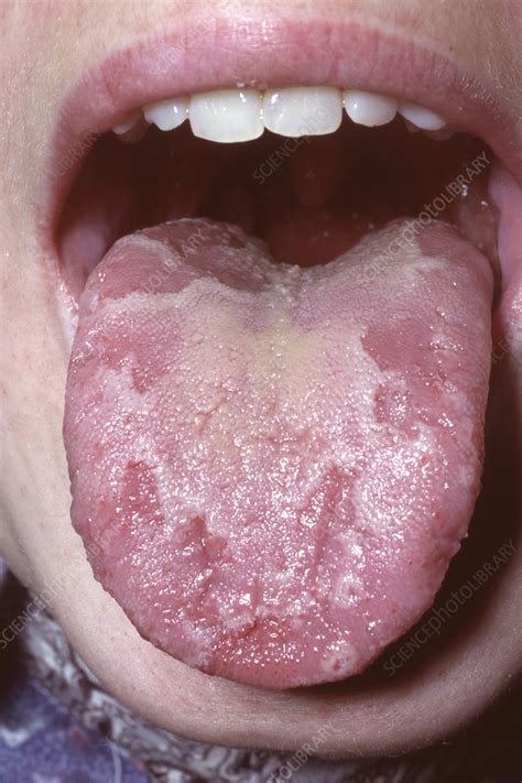 Geographic Tongue Stock Image C0494505 Science Photo Library