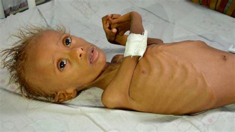 un report 7 million in yemen on verge of starvation