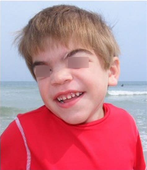 Sanfilippo syndrome is a type of rare form of lysosomal storage disease that is inherited in an autosomal recessive pattern. Sanfilippo syndrome pictures