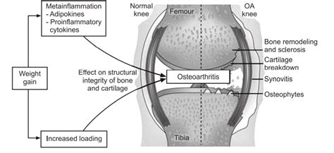 Osteoarthritis Oa Treatments And Drugs Solution Parmacy