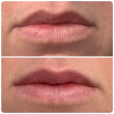 Lip Flip With Botox Results Dana Carolyn