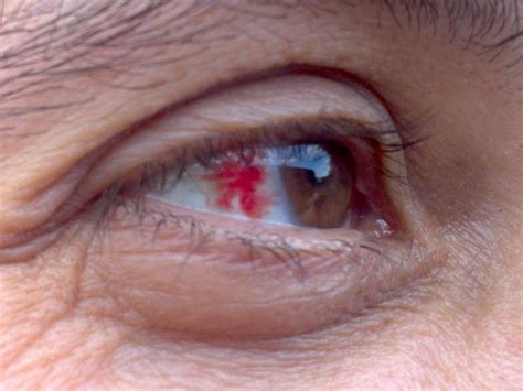 Signs Of Disease In The Eyes Business Insider