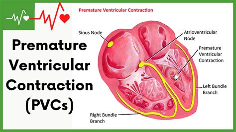 Premature Ventricular Contraction Pvcs An Overview