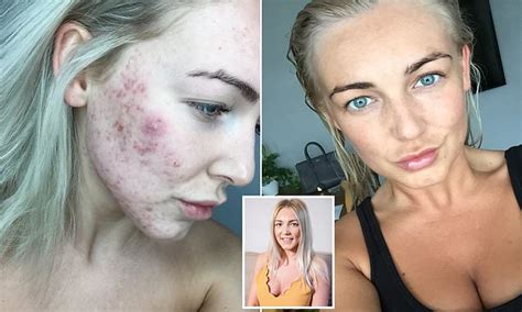 Swinton Girl Cures Her Acne With Controversial Drug Roaccutane Daily Mail Online