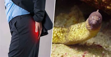 Man Almost Dies After Putting Eel Up His Rear End To Cure Constipation