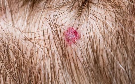 Scalp Folliculitis Is A Condition In Which Boils Or Painful Rashes