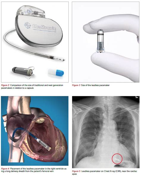 Next Generation Cardiac Implantable Electronic Devices Singhealth
