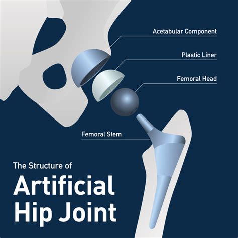 Hip Replacement In East Central Minnesota Welia Health