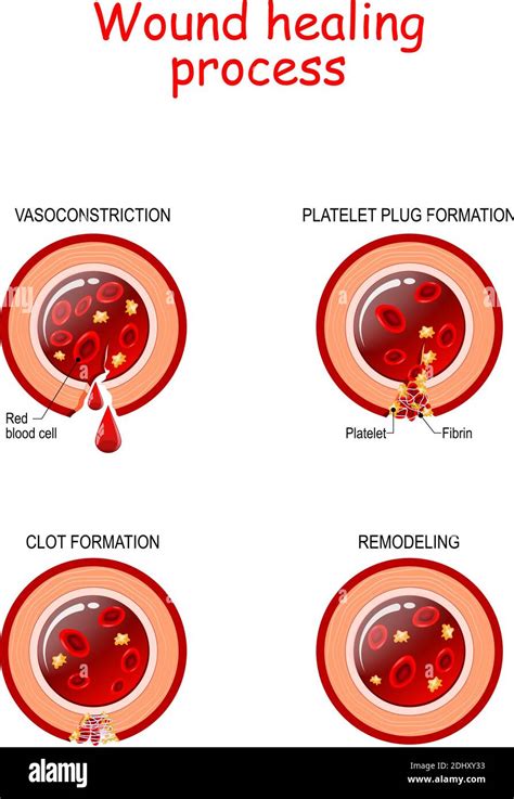 Phases Of The Wound Healing Process Hemostasis Inflammatory