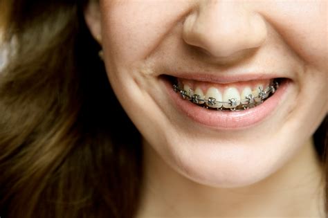 Everything You Need To Know About Braces Jl Dental Blog