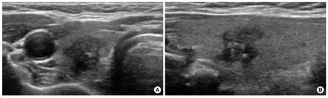 Ultrasonography Us Of Papillary Thyroid Cancer In A 60 Year Old Woman