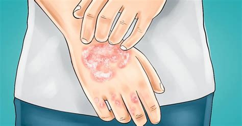 Maybe you would like to learn more about one of these? 12 Foods That Make Eczema Worse | Healthy Food House