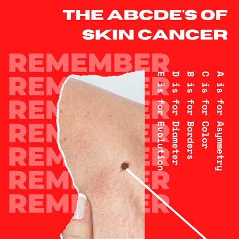 Abcdes Of Skin Cancer Is It A Mole Or Skin Cancer Lani And Kai