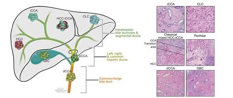 Cell Of Origin In Biliary Tract Cancers And Clinical Implications