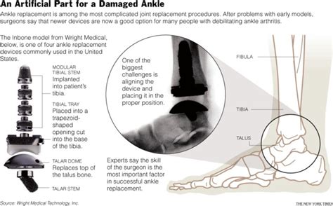 Ankles Gain As Candidates For Joint Replacement The New York Times