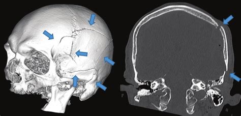 A Patient With A Skull Fracture Fracture Sites Are Marked With Arrows