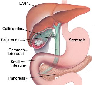 A look at gallbladder sludge, which is a collection of cholesterol, calcium, bilirubin, and other compounds that build up in the gallbladder. Laparoscopic Cholecystectomy - DSSurgery