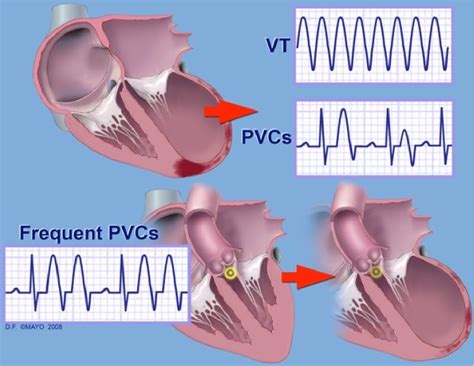 Figure 1 From Premature Ventricular Contractions And Non Sustained Ventricular Tachycardia