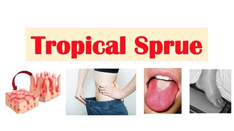 Tropical Sprue Causes Pathogenesis Signs And Symptoms Diagnosis