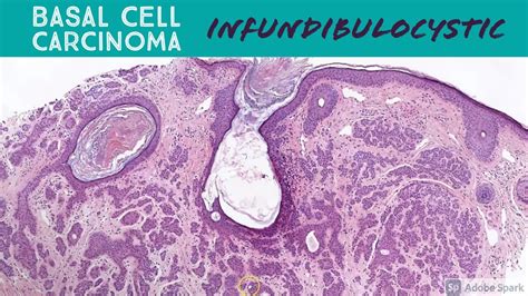 Basal Call Carcinoma Infundibulocystic Type Dermpath Dermatology