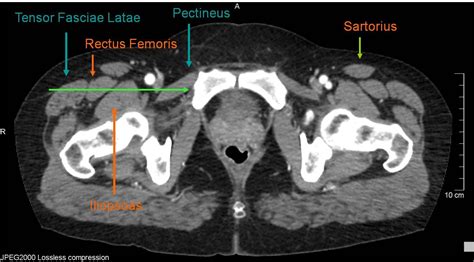 Muscles In The Inguinal Region Tensor Fasciae Latae Muscle Radiology