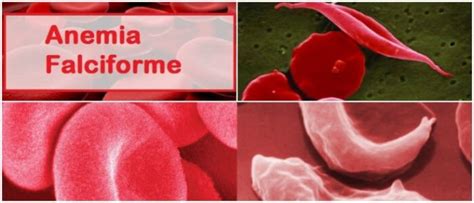 Sickle Cell Anemia: Causes, Diagnosis, Symptoms, Treatment ...