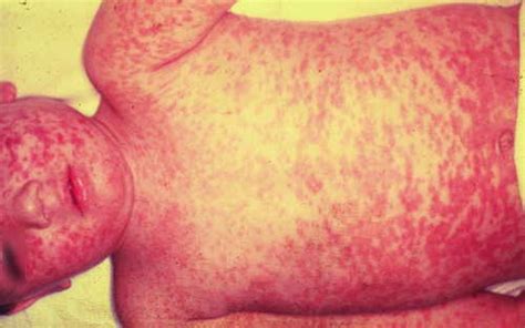 Healthoolrubeola Measles First Disease Rash Pictures Atlas Of Rashes