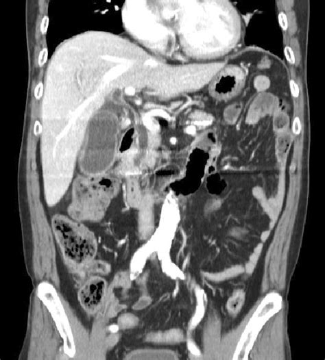 Preoperative Image Of Patient Ct Scan Shows A Stone In The Cystic Duct
