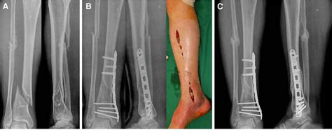 Minimally Invasive Plate Osteosynthesis Of Distal Tibial Fractures A