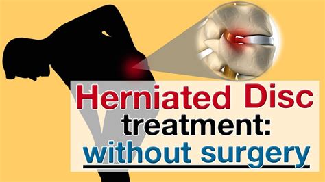 Your best alternative to spine surgery in malaysia. Herniated Disc without surgery: treatment options - YouTube
