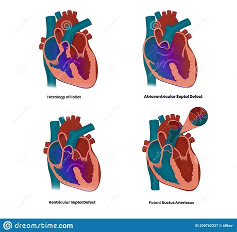 Vector Illustration Of The Heart Defects Linked To The Down Syndrome