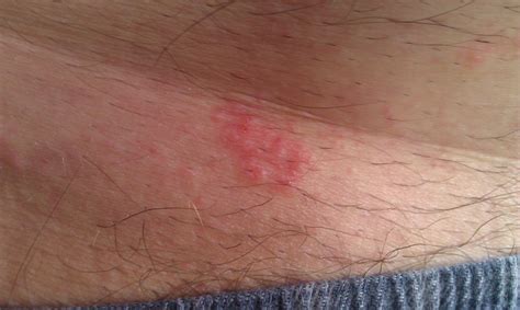 Rash On Sides Of Torso Pictures Photos