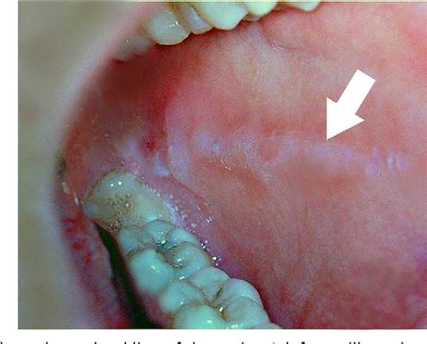 Normal Variations Of Oral Anatomy And Common Oral Soft Tissue Lesions