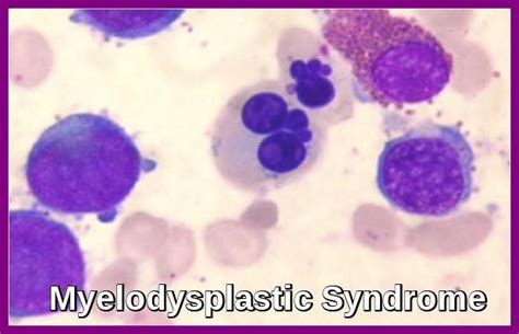 Myelodysplastic Syndrome Ask Hematologist Understand Hematology