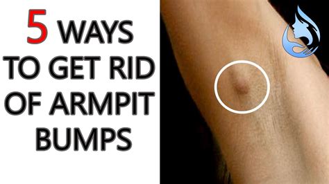 Ways To Get Rid Of Armpit Bumps Youtube