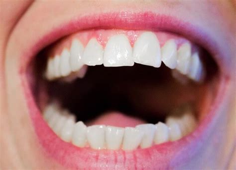 What Exactly Is Gum Disease Important Things You Need To Know