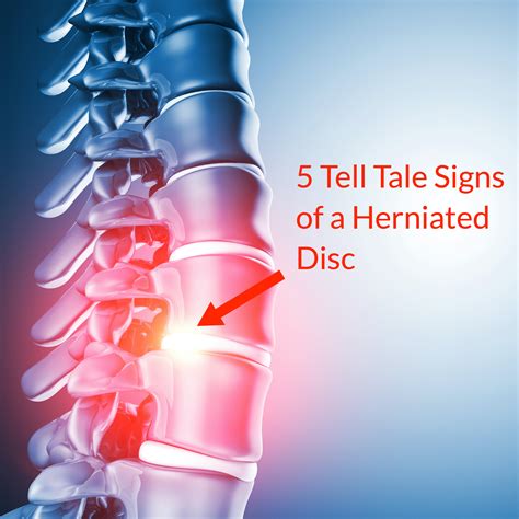 Tell Tale Signs Of A Herniated Disc Slipped Disc Fornham Chiropractic Clinic