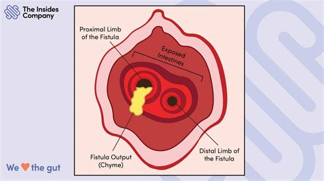 What Is An Enterocutaneous Fistula And Enteroatmospheric Fistula